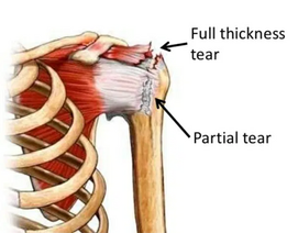 READ THIS! Before Shoulder Surgery
