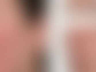 Why Is My Face Always Red? Common Causes of Facial Redness