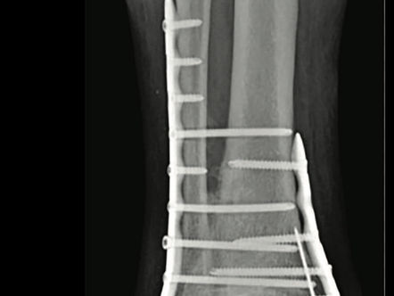 My Triple (Trimalleolar) Fracture - A New Healing Journey Begins