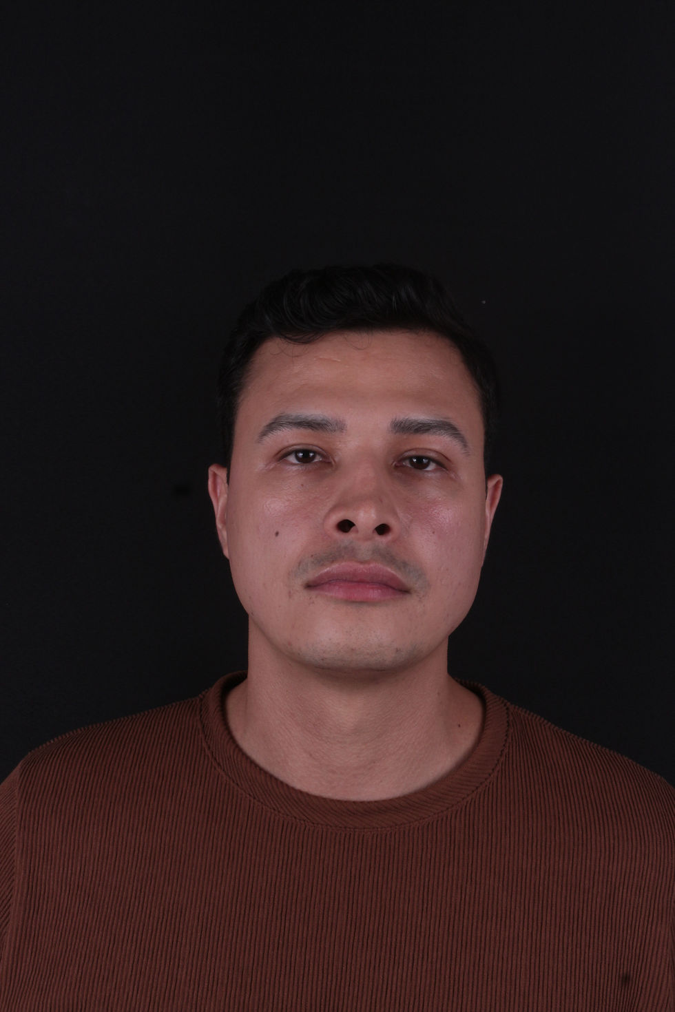 Depois - Próteses Faciais de Polietileo Poroso - Dr. Samir Murador