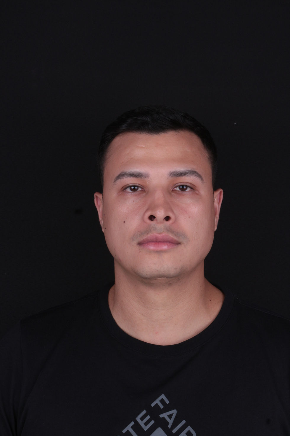 Antes - Próteses Faciais de Polietileno Poroso - Dr. Samir Murador