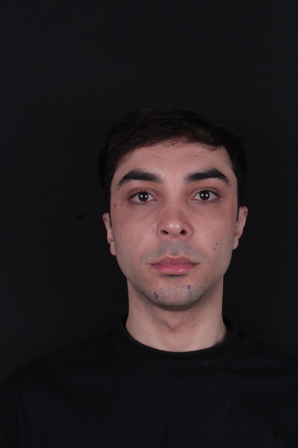 Antes - Próteses Faciais de Polietileno Poroso - Dr. Samir Murador