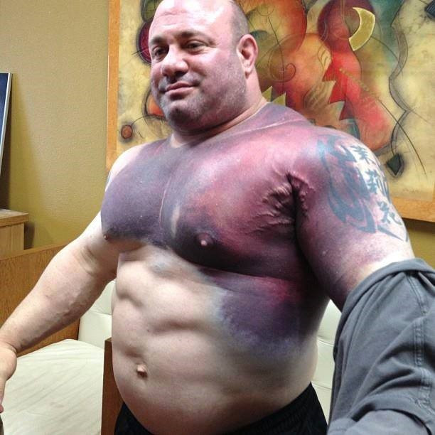 A bodybuilder pictured from the waist up. They have a gigantic, deep purple and rec bruise covering both pecs, as well as the left shoulder, upper traps and part of the abdomen.
