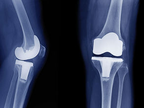 How Pre Op and Post Op Physical Therapy Help Improve Knee Replacement Recovery