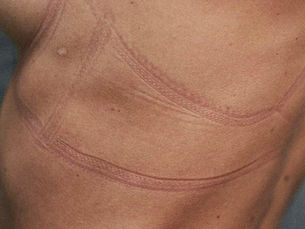 skin irritation marks from wearing a bra that sits too tightly. close up image of the red marks left on the ribcage of a women.