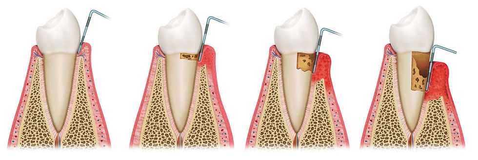 Periodontal disease is inflammation and infection of your gums and the bone that supports your teeth.