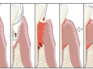 Treat gum disease without surgery using LANAP laser therapy in NYC and NJ. Learn benefits, recovery, and results at Bright Smile Design Dental.