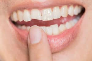 Chipped or Cracked Teeth Can Be Treated in a Variety of Ways