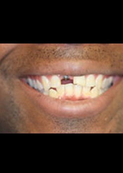 Dental Implants, before