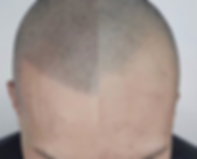 Haarpigmentierung vorher nachher