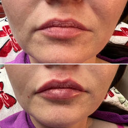 Lip Filler