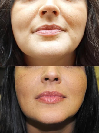 Low Face Filler