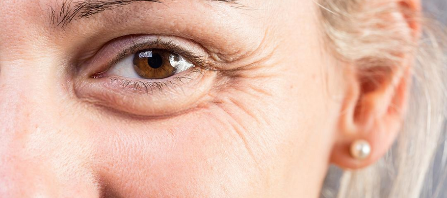 best treatment for crow’s feet get rid of crow’s feet get rid of eye wrinkles eye wrinkle treatment smooth crow’s feet smooth eye wrinkles corona aesthetics medical clinic corona aesthetician medspa