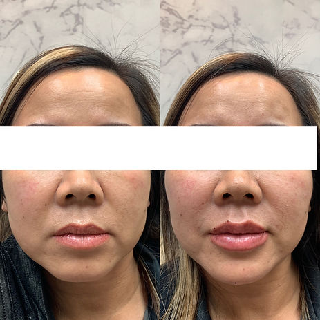 Lip-filler-before-and-after-jpg.JPEG