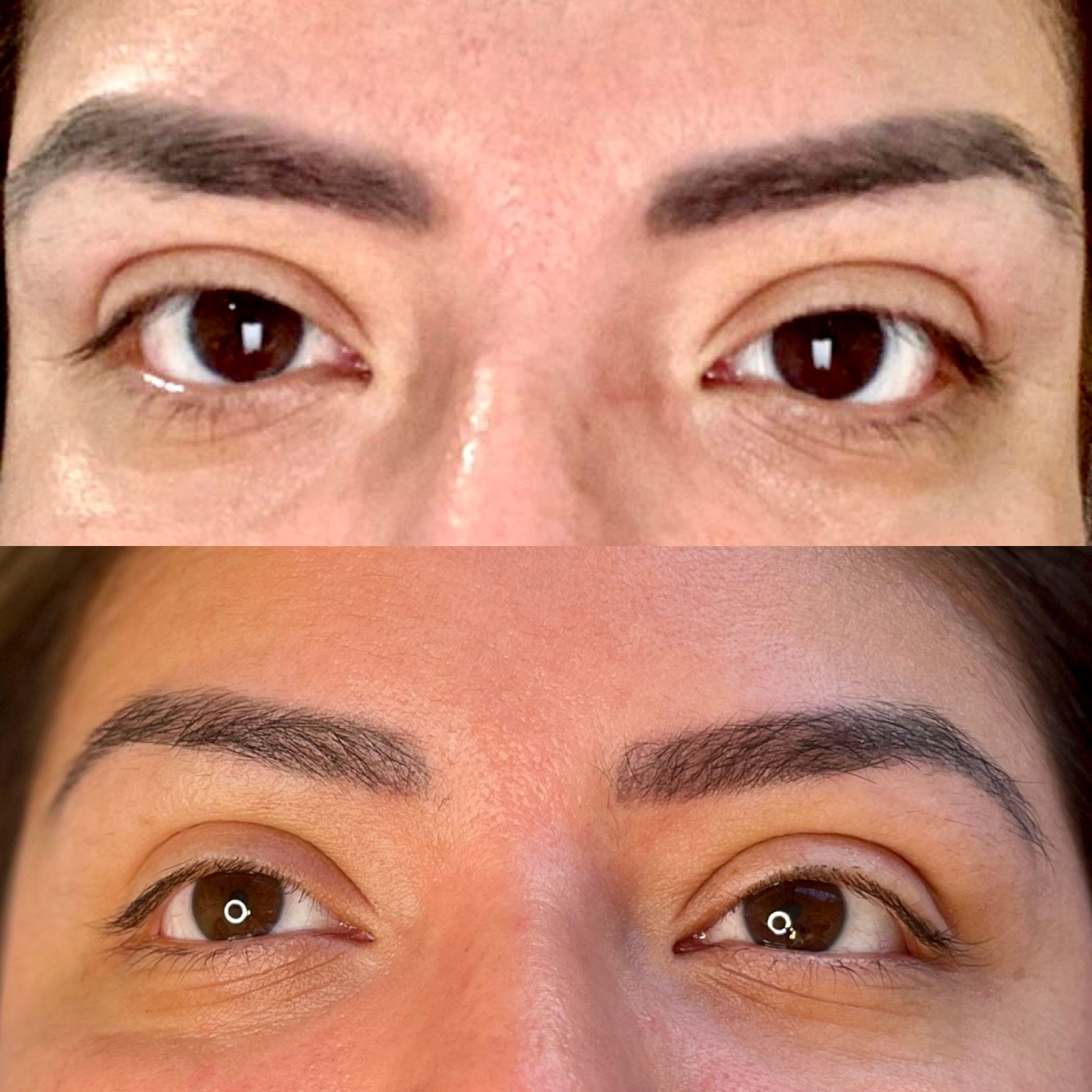 magnetic tattoo removal