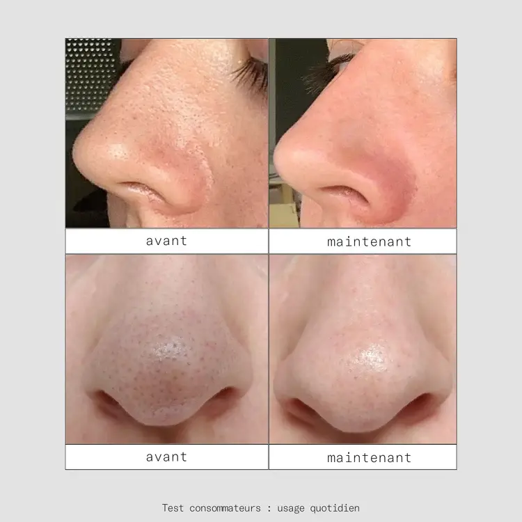 Miniature : ROUTINE SOS POINTS NOIRS ET PORES - Skin and Out