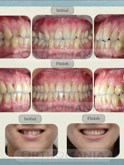 如何避免矯正造成的牙齦萎縮?