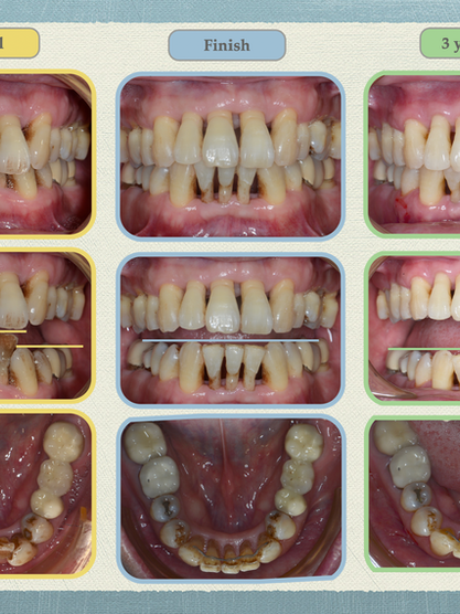 有嚴重牙周病,可以矯正嗎?