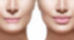 lip-fillers-before-and-after.jpg