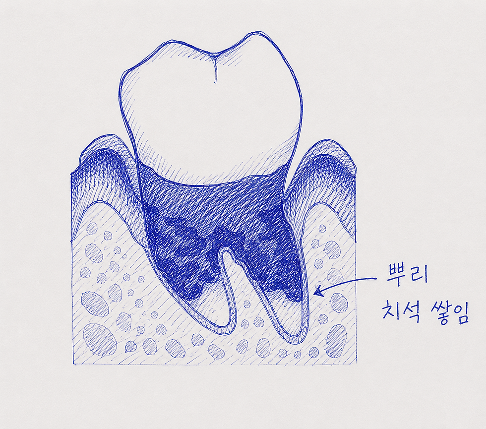 잇몸 아래 치석