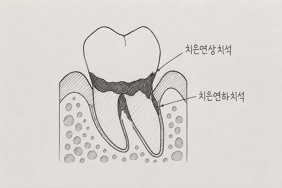 치은 연상,연하 치석