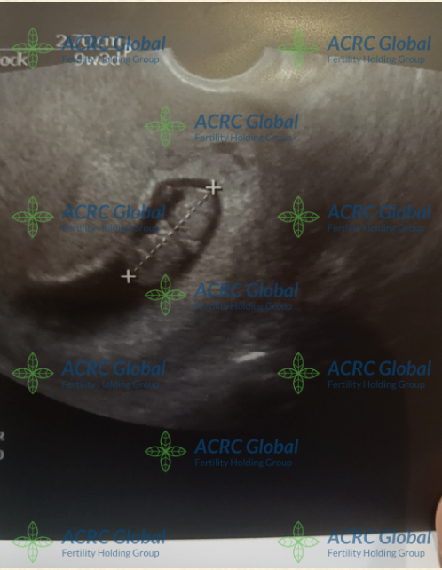 Ultra sound for surrogate J with ACRC surrogacy