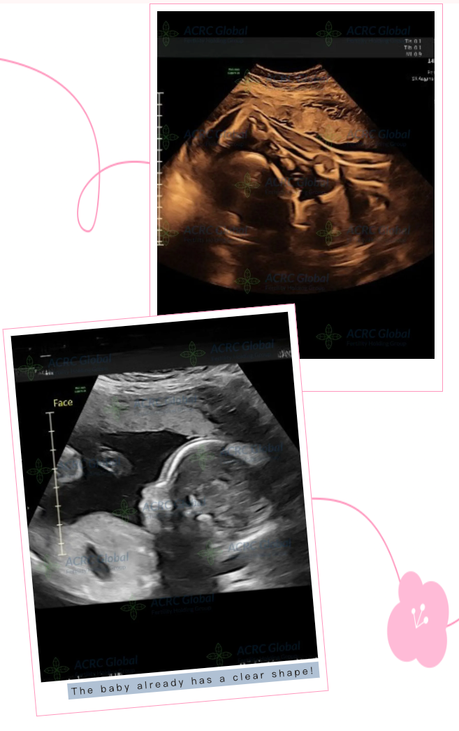 Ultra sound ACRC surrogacy surrogate