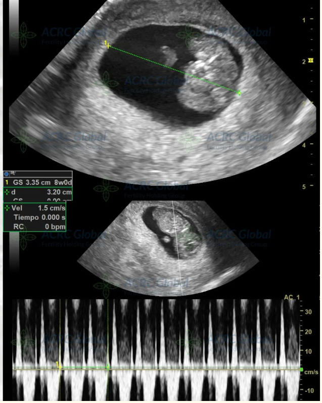 A 10 Week Pregnancy Milestone for Intended Parents from Japan