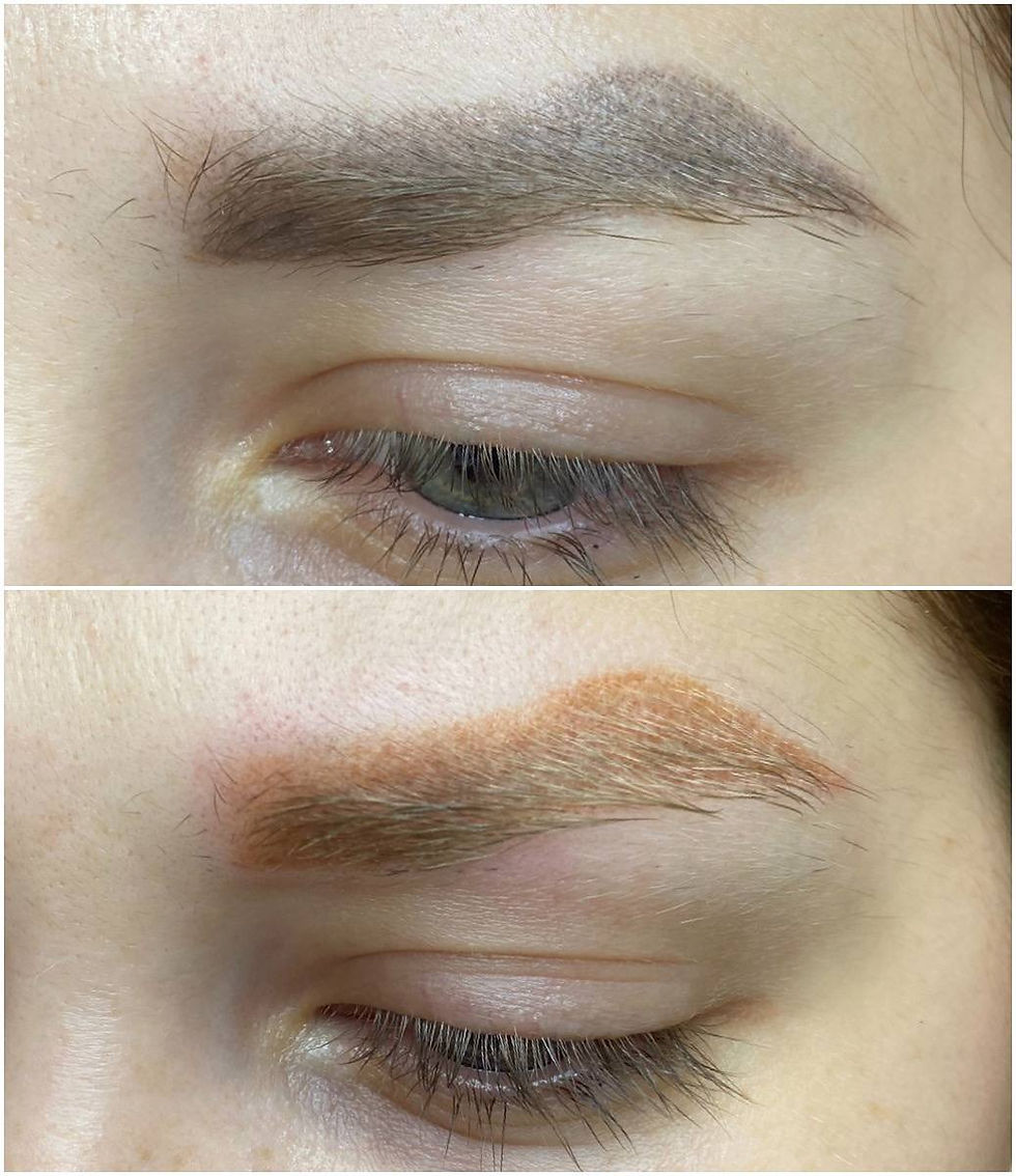 Das gelbe Pigment in der Haut nach der Entfernung des Permanent Make-ups der Augenbrauen ist der Rückstand eines instabilen organischen Farbstoffs, der vom Laser nicht entfernt wird.