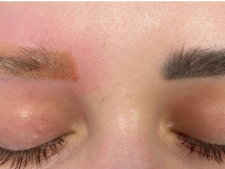 El residuo amarillo tras la eliminación láser del maquillaje permanente de cejas es la consecuencia del pigmento amarillo orgánico.