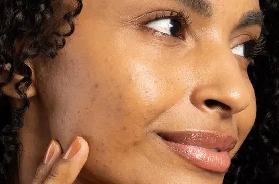modelo-com-acne.webp