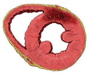 Infarto de Miocardio en la pared anterior del ventrículo izquierdo con arterias coronarias permeables (by Patrick Lynch)