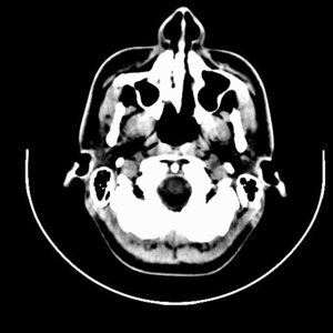 300px-TAC_Brain_tumor_glioblastoma_After_2_month_of_the_operation-Transverse_plane