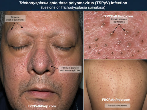 Trichodysplasia Spinulosa Polyomavirus (TSPyV)