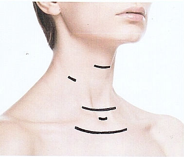 Professor Delbridge thyroid surgeon Sydney thyroidectomy incision