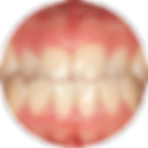 Aparelho dental transparente