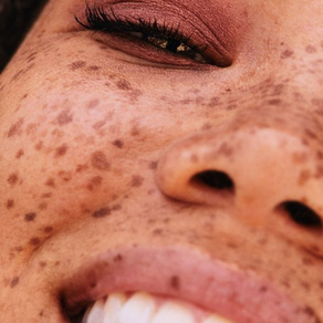 Y Esto Que Tengo Serán ¿Manchas o Pecas?