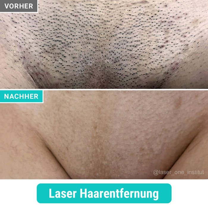 Dauerhafte Haarentfernung Bikini