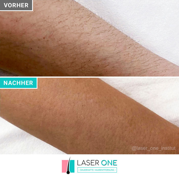 Laser Haarentfernung Ergebnisse