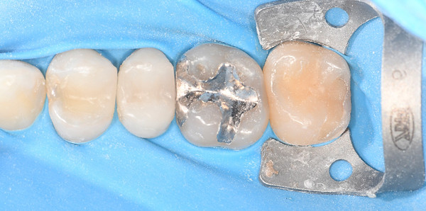 ラバーダム後の歯