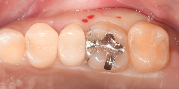 ラバーダム前の歯
