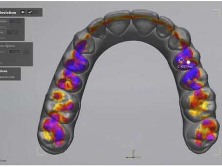 Contatos oclusais e tratamento com o aparelho Invisalign: previsibilidade e resultados alcançados