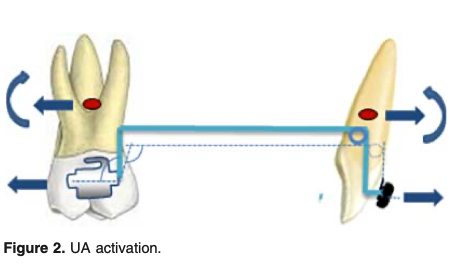 Eficácia do arco utilitário com elásticos intermaxilares no tratamento da mordida profunda