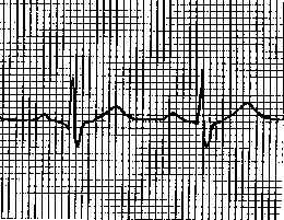 ekg.gif