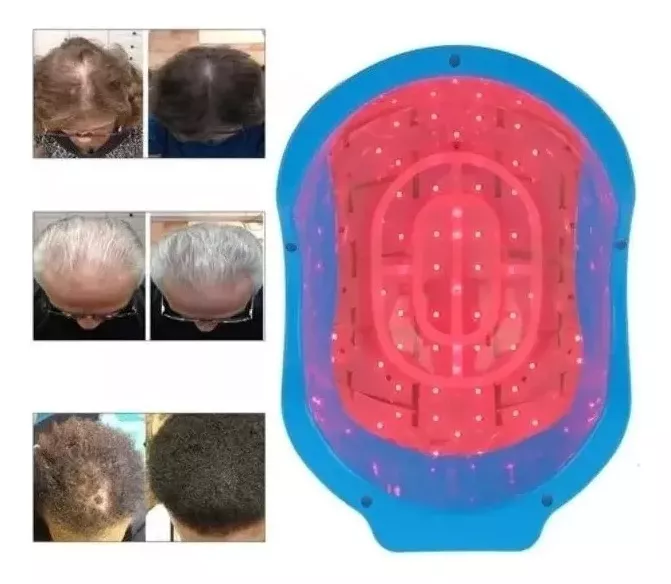 Miniatura: Casco Tratamiento Estimula Crecimiento Cabello Alopecia