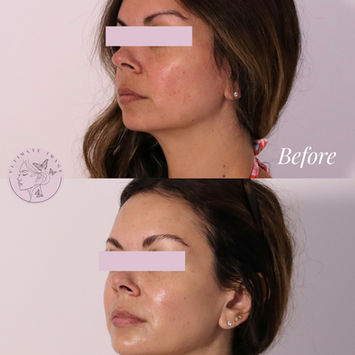 Dermal Fillers