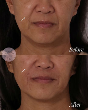 Soften nasolabial folds and marionette lines while restoring natural volume to the midface