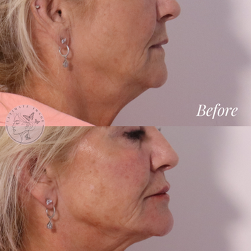 Dermal Fillers
