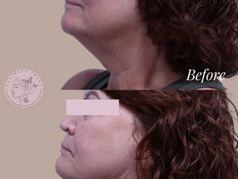 Tighten and lift sagging skin for a more youthful appearance