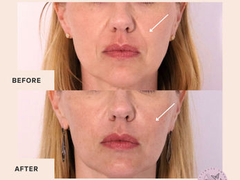 Smooth and enhance the appearance of smile lines